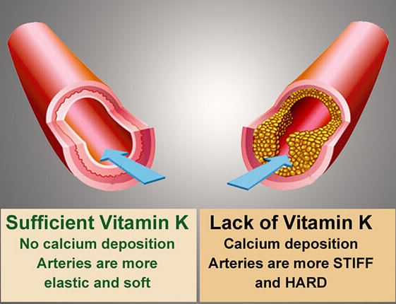 비타민 K2의 효능;혈관석회화억제,심혈관건강,뼈건강,골다공증예방