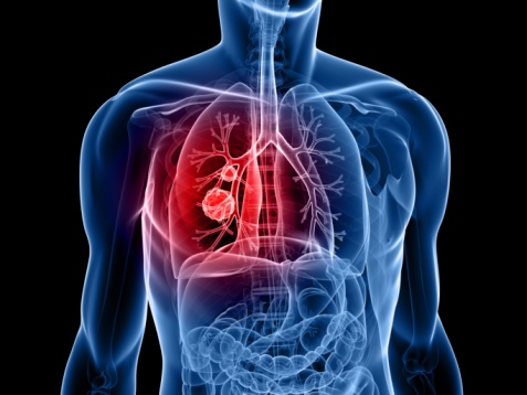 호흡기 질환 (특발성 폐섬유화증,만성 폐쇄성 폐질환등)