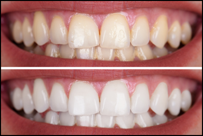 치아미백제 사용법 및 부작용