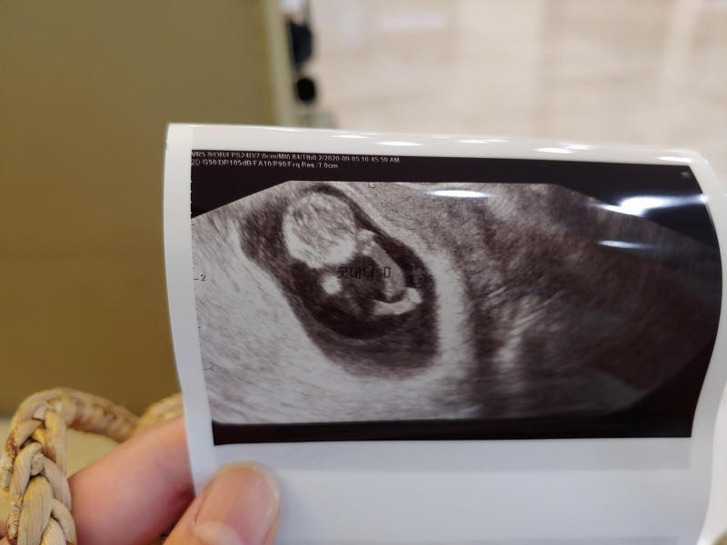 임신 3개월 증상과 태아 목투명대 검사기준