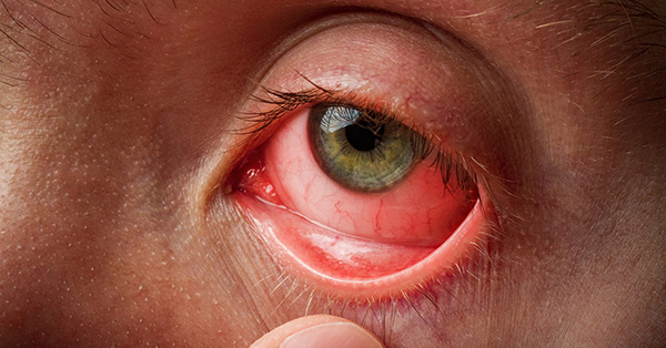 눈 실핏줄이 터지는 이유 결막하출혈의 원인과 치료법
