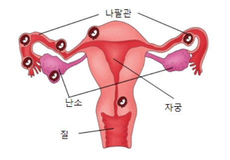 자궁외임신 증상과 치료방법