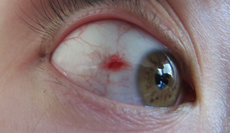 혈액순환 장애의 적신호: 눈 핏줄이 터지는 결막하출혈