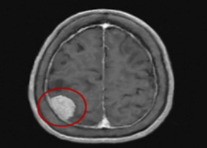 뇌종양 초기증상/진행단계/치료방법/부작용