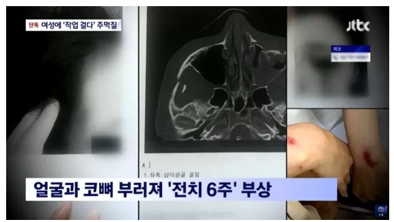 강남 전화번호 요구 거절 여성 주먹질 폭행한 남성 '코뼈 부러져 전치 6주'