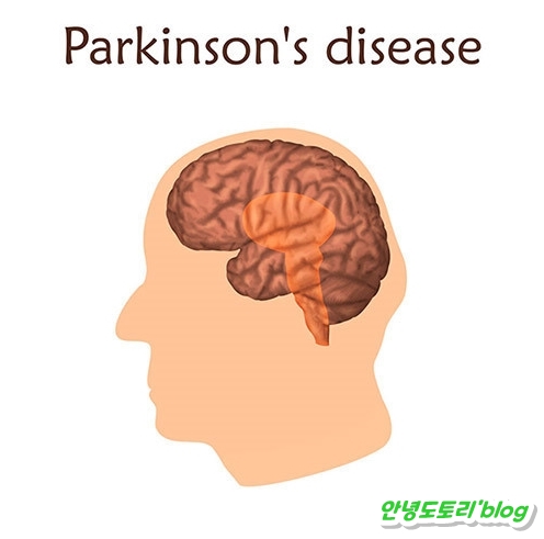 파킨슨병 증상 및 치료방법