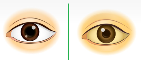 눈 흰자가 노란색, 황달 증상 원인 및 증상