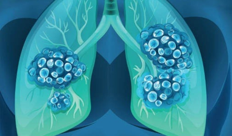 폐암4기 생존기간 생존률