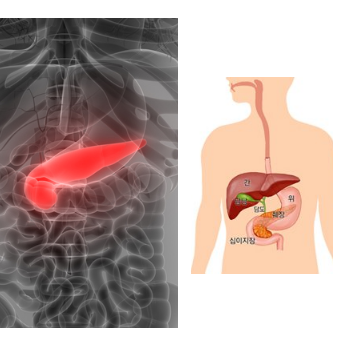 췌장암 초기증상  조기발견율 5%이하