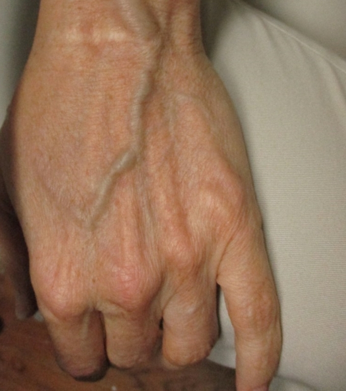 손 등 핏줄 튀어나옴 / 손등정맥류 원인 치료 방법