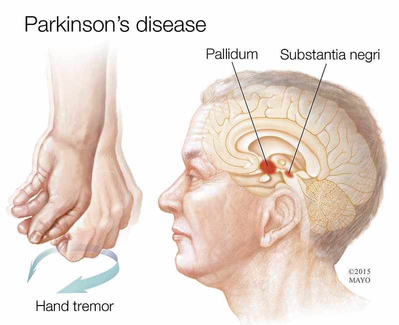 노령인구에서 급증하는 신경 퇴행성 질환, 파킨슨 병