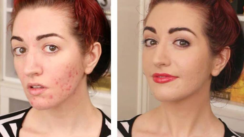 15년간 지독한 여드름 피부로 살던 여성이 '이것'끊자 얼굴에 생긴 놀라운 변화