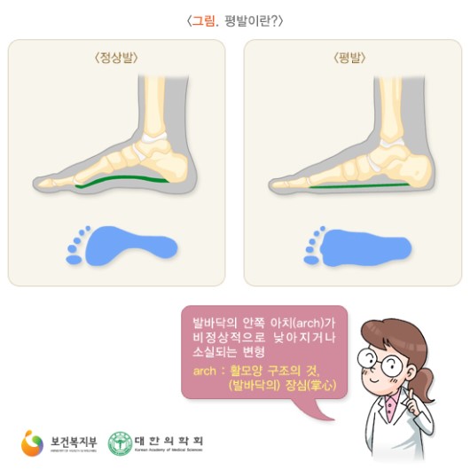 평발이란..? 평발의 증상은 어떨까요..?