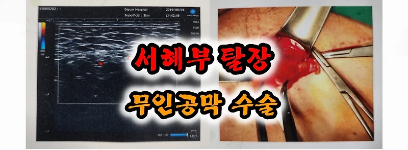 서혜부 탈장 무인공망 수술 전문 병원