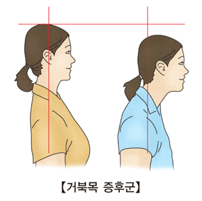 자세 교정 - 라운드 숄더(거북목) 교정법