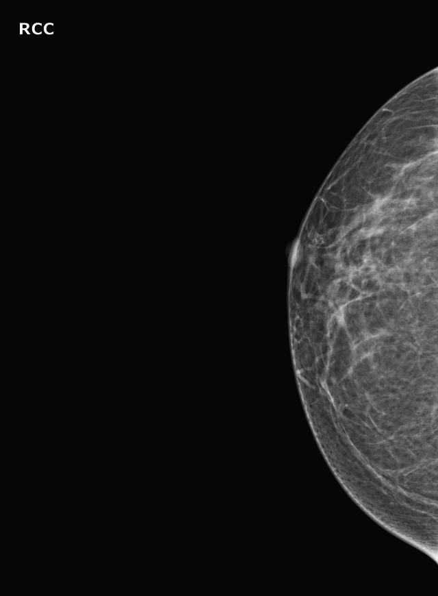 건강 검진 - 유방암 검사의 방법