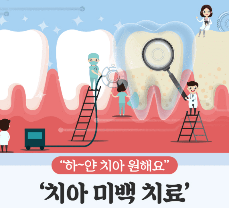 치아미백 종류 부작용 시술방법 가격 / 연예인 치아미백?