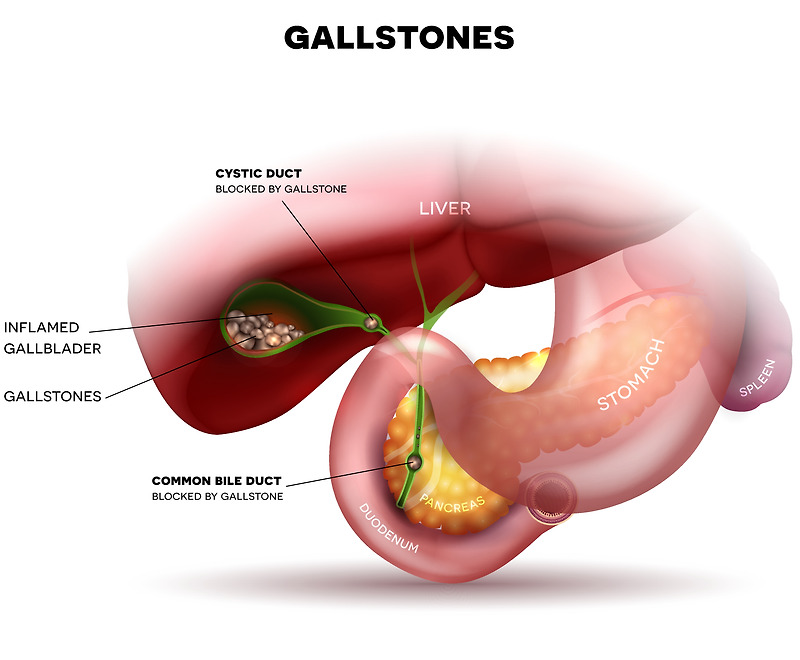 담석증(Cholelithiasis, GB stone), 담낭 결석으로 심각한 복부 통증의 양상은?