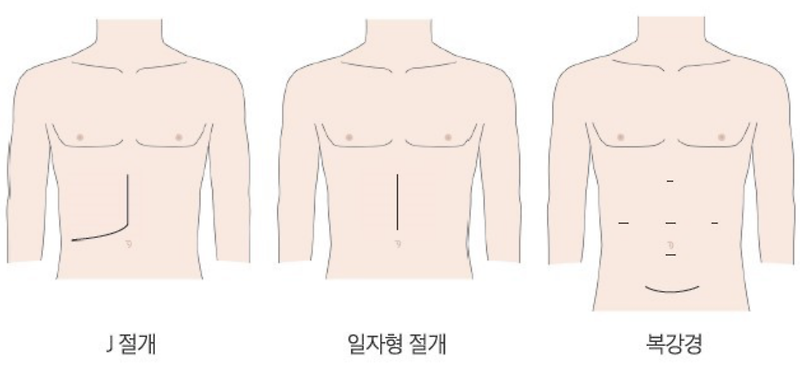 [간이식 수술] Ch.3 - 수술 방법•상처•흉터  (2:1 간이식)