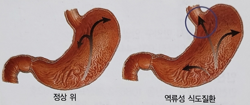 가슴 불편, 위산 역류일 수도? 역류성 식도염의 증상과 치료 방법