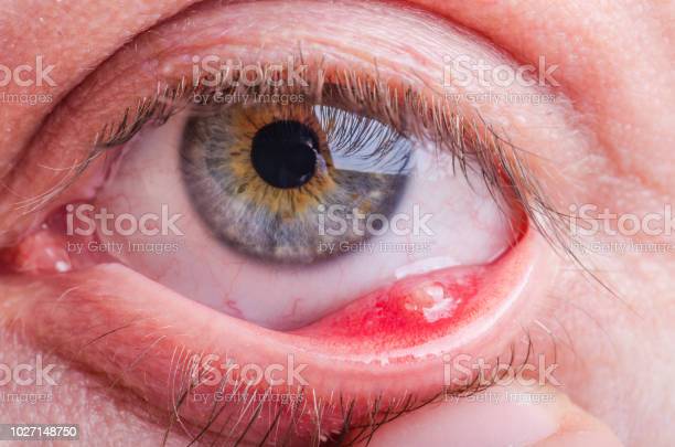 눈다래끼의 원인 및 증상과 치료방법