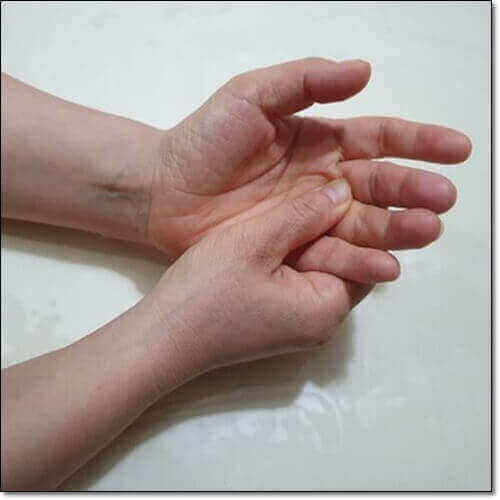 손 떨림 원인 진전증, 증상과 치료 및 예방
