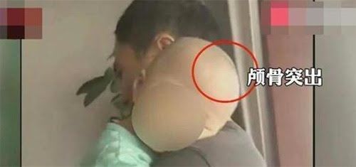 중국에서 가짜 분유가 돌면서 이를 먹은 영유아의 두개골이 기형