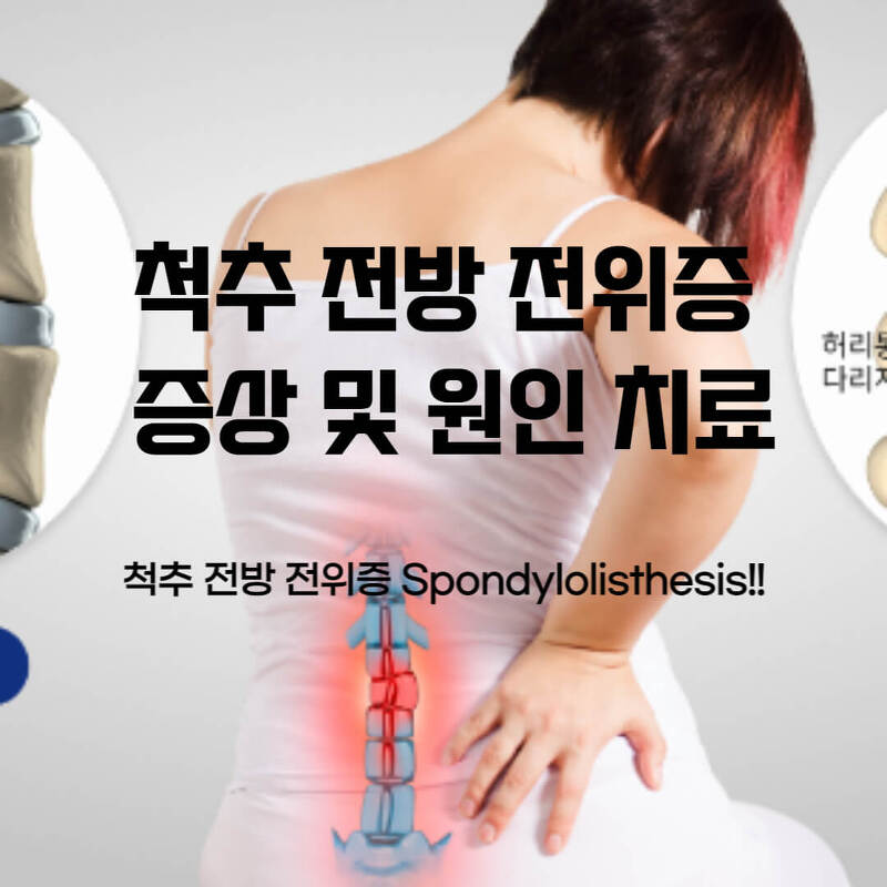 척추 전방 전위증(Spondylolisthesis) 증상 및 원인 치료