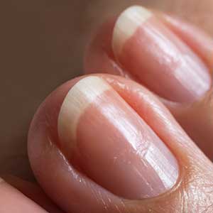 손톱에 세로줄이 생기는 이유 10가지 대처방법