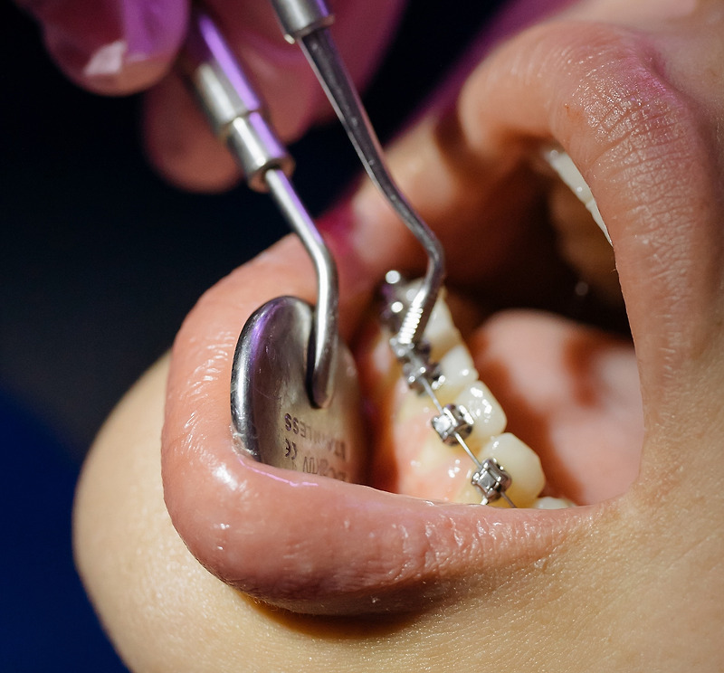 묘교정을 통한 비수술·비발치 치아 재교정의 장단점과 기간·비용