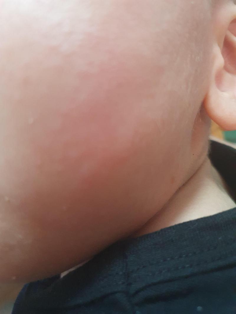 두돌 아기 팥 알레르기
