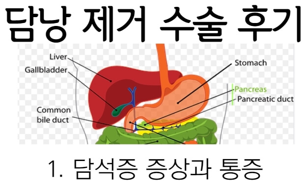 담낭 제거 수술 후기① : 담석증 증상