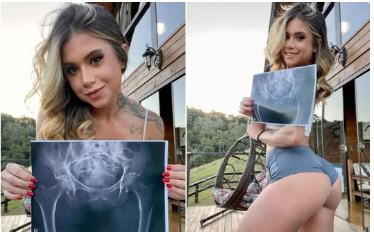 40인치 예쁜 엉덩이 브라질 인플루언서 라리사 숨파니 성형악플에 엑스레이 사진 공개