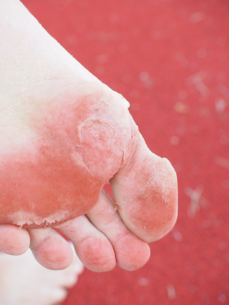 발 습진과 무좀 차이 와 발 습진 치료