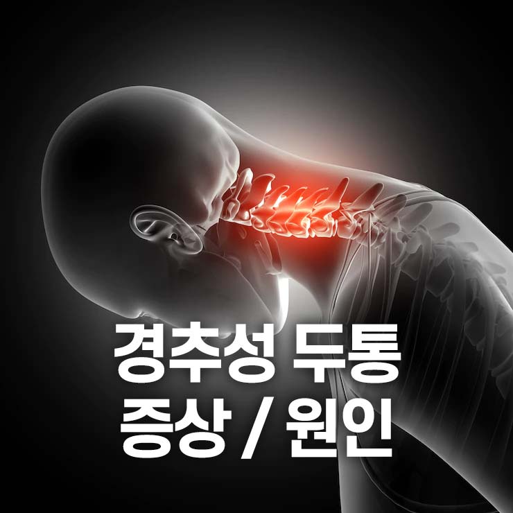 경추성 두통 증상과 원인, 치료방법, 스트레칭 / 거북목, 일자목