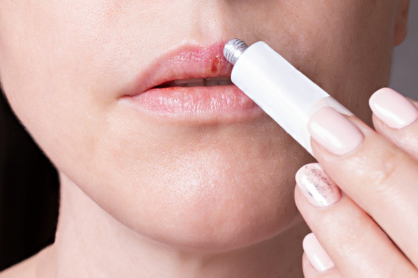 입술 부어오름 증상의 이유는 뭘까 알아볼 수 있는 질환