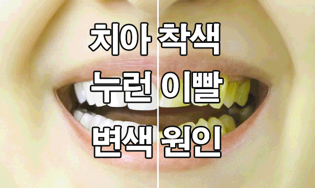 치아 착색, 누런 이빨 : 변색 원인