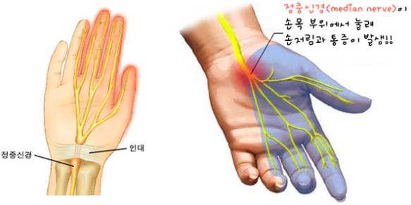 손목통증 치료방법 4가지 알아보기