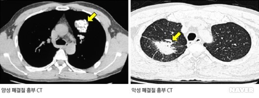 흉부 X-ray/CT 영상 분석을 통한 폐암 진단 알고리즘 - 폐종양과 폐결절
