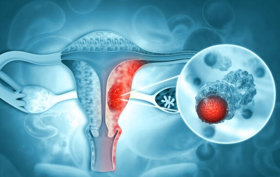 여성들에 대한 위협, 자궁경부암의 원인과 증상 치료방법은?