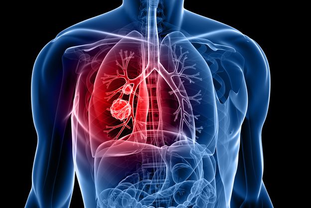 폐암 3기 전이 면역력 관리가 필수인 이유