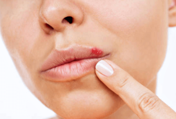 입술포진의 전조증상과 치료방법 및 주의사항