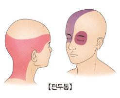 두통 원인/증상/종류