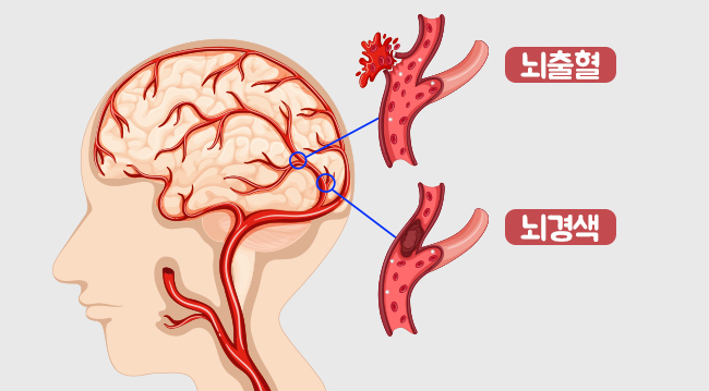 뇌졸중 전조증상 11가지 및 예방