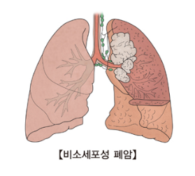 폐암 초기증상/원인/치료법