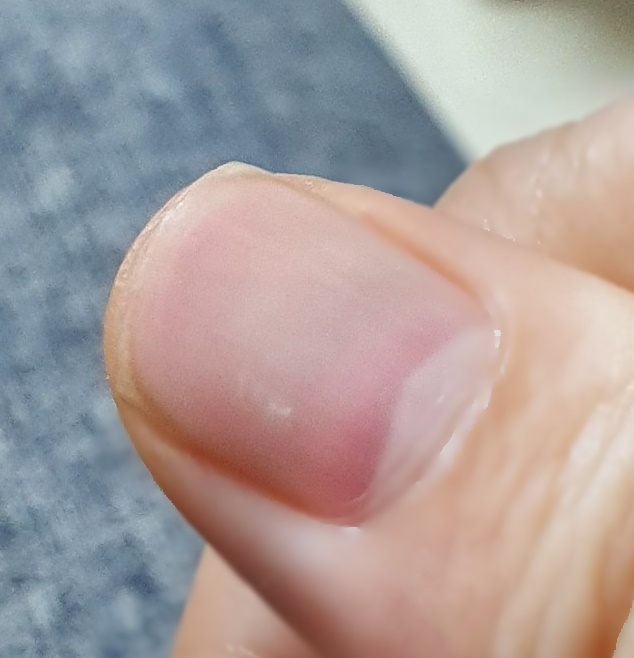 [건강] 손톱 하얀 반점은 왜 생기는 걸까?
