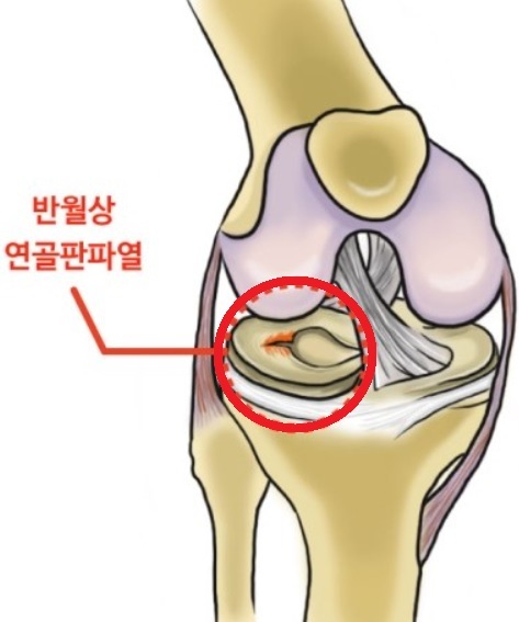 무릎연골 찢어짐 수술과 재활법 강력추천