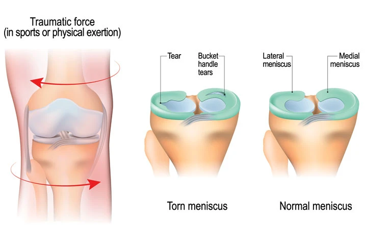 무릎 반월상연골 손상 후 재활운동 과정