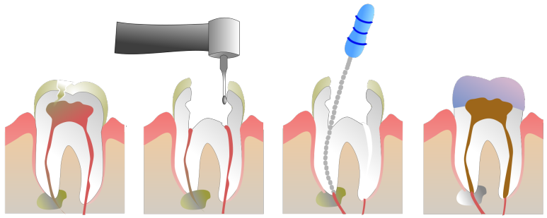 치아 신경치료 과정 알아보기