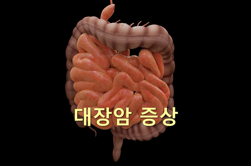 대장암 증상과 대장암 4기 생존율